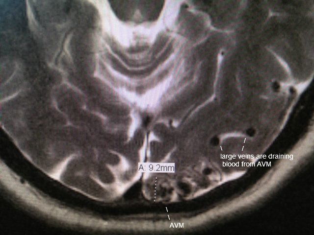 Аневризма галена у новорожденных. Артериовенозная мальформация вены Галена. Артериовенозная мальформация головного мозга на кт. Мальформация вены Галена мрт.